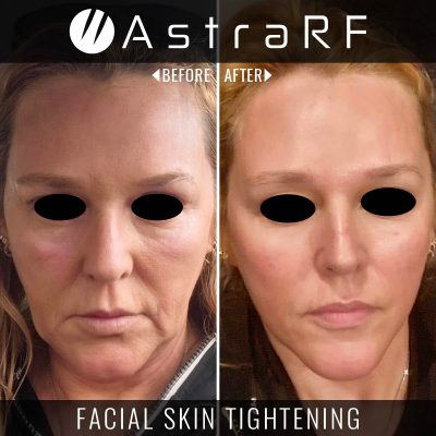 Astra-RF-Photo-SQ03